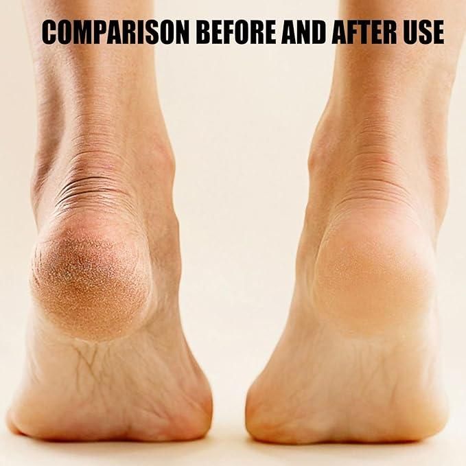 Electronic Pedicure Tool – Smooth, Soft Feet in Minutes!