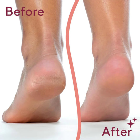 SilkStep™ - Rechargeable Electric Foot Callus Remover